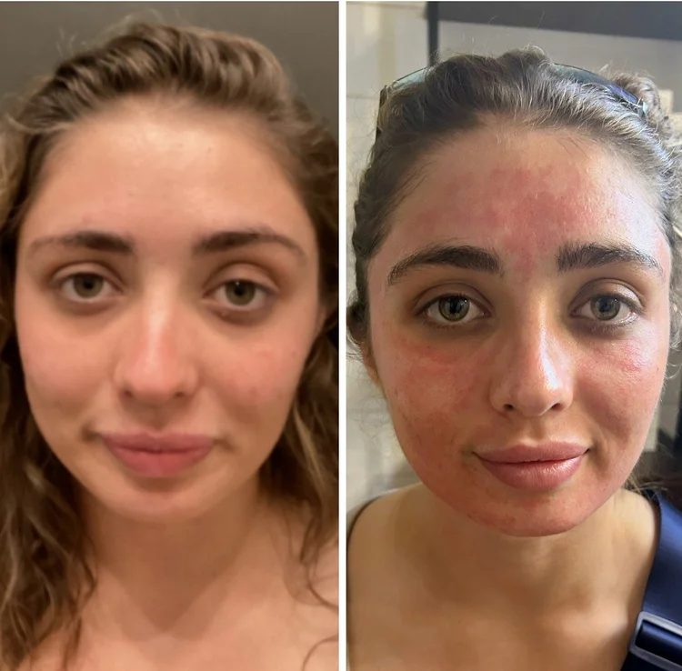 Microneedling+ before after