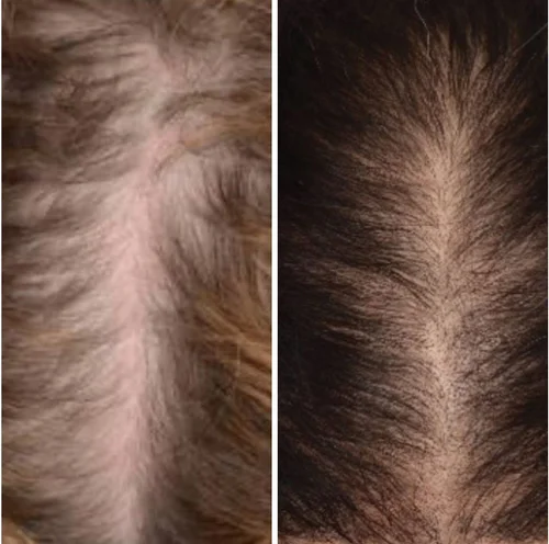 hair+restoration 1