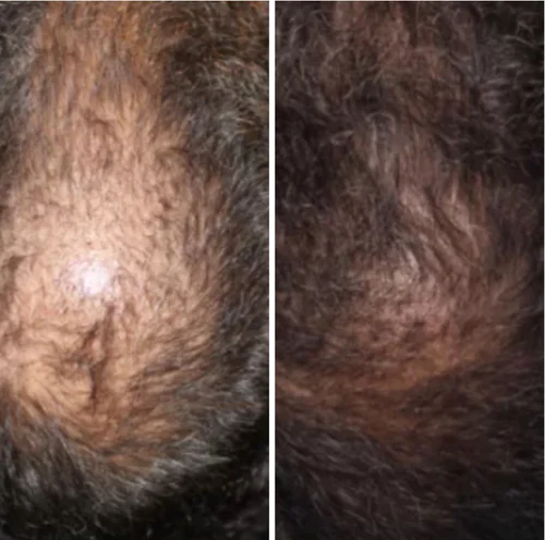 hair+restoration+2