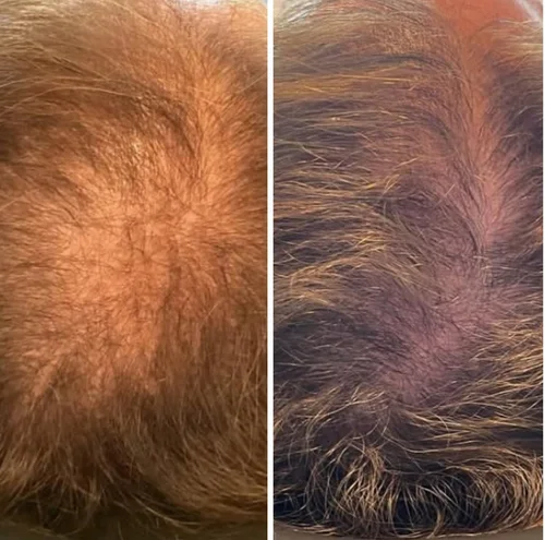 hair+restoration+3